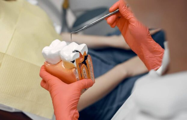 Quelles sont les causes de la carie dentaire ?