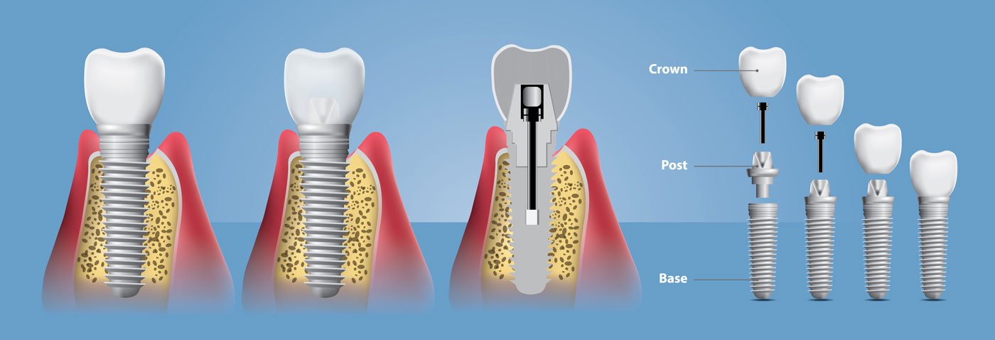 Implantat Behandlung in Alanya