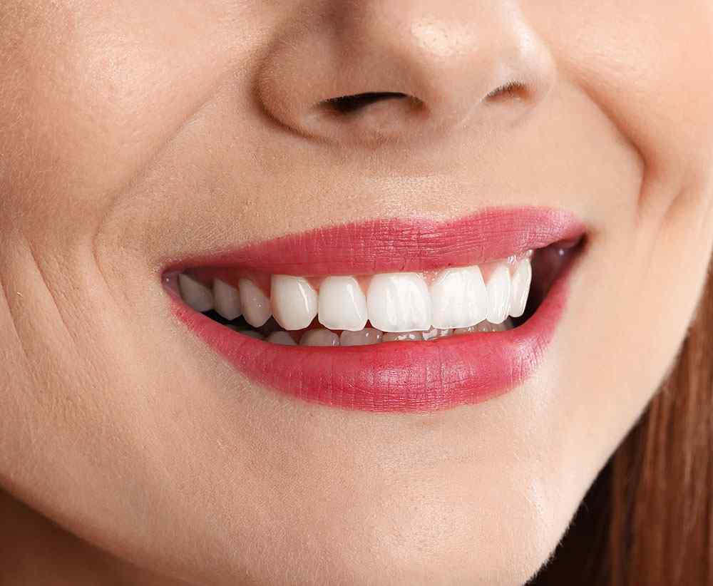 Blanchiment Des Dents Alanya