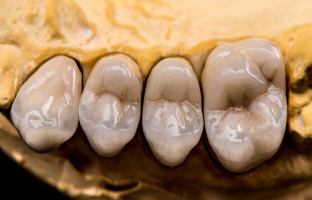 Was sind die Vorteile von Zirkoniumdioxid-Veneers?