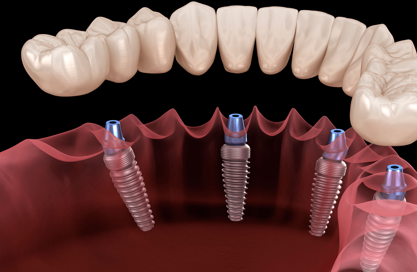 L’implant Dentaire Agressif