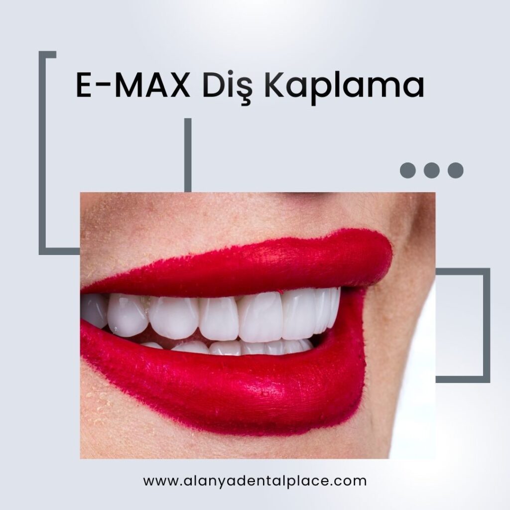 emax dental veneers