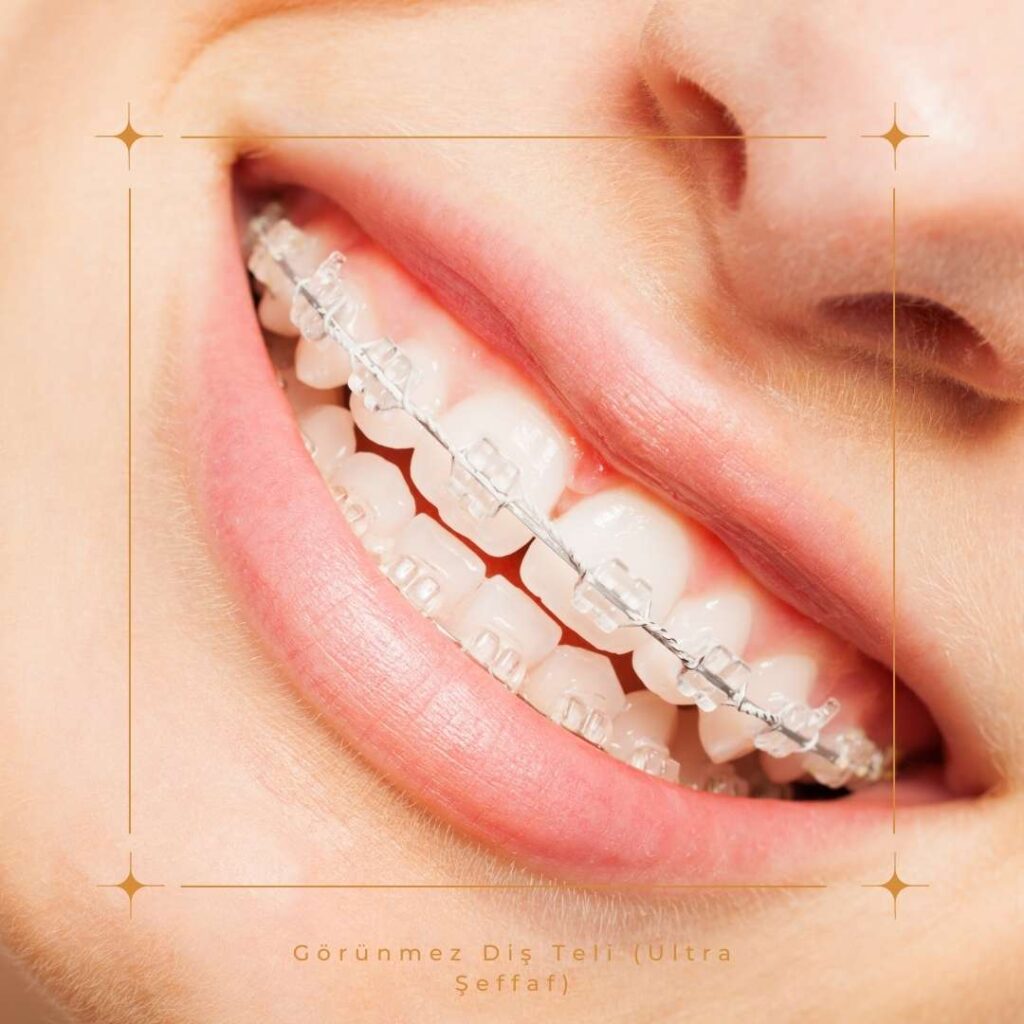 Görünmez Diş Teli Tedavisi Ne Kadar Sürer?