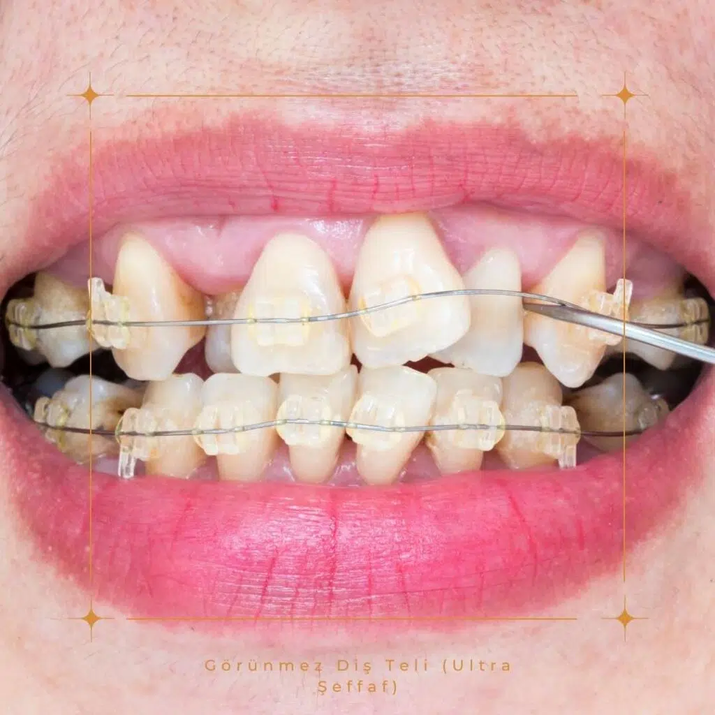 Diş Teli Her Yaştan İnsana Uygulanır Mı?