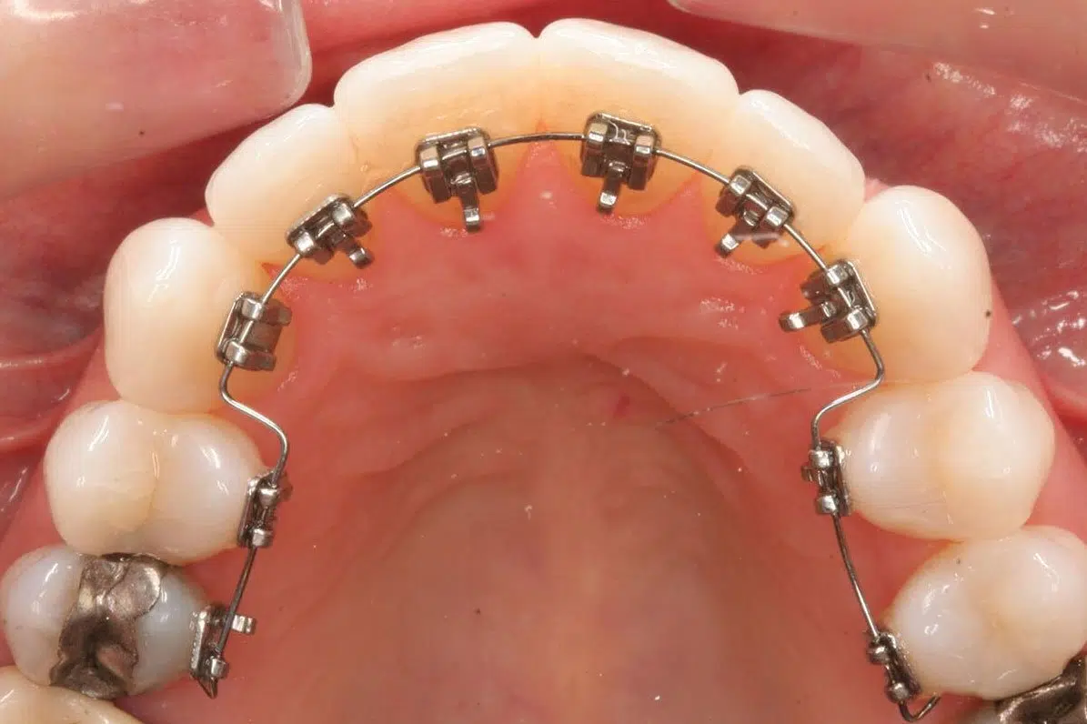 Orthodontics Braces Alanya Antalya 2