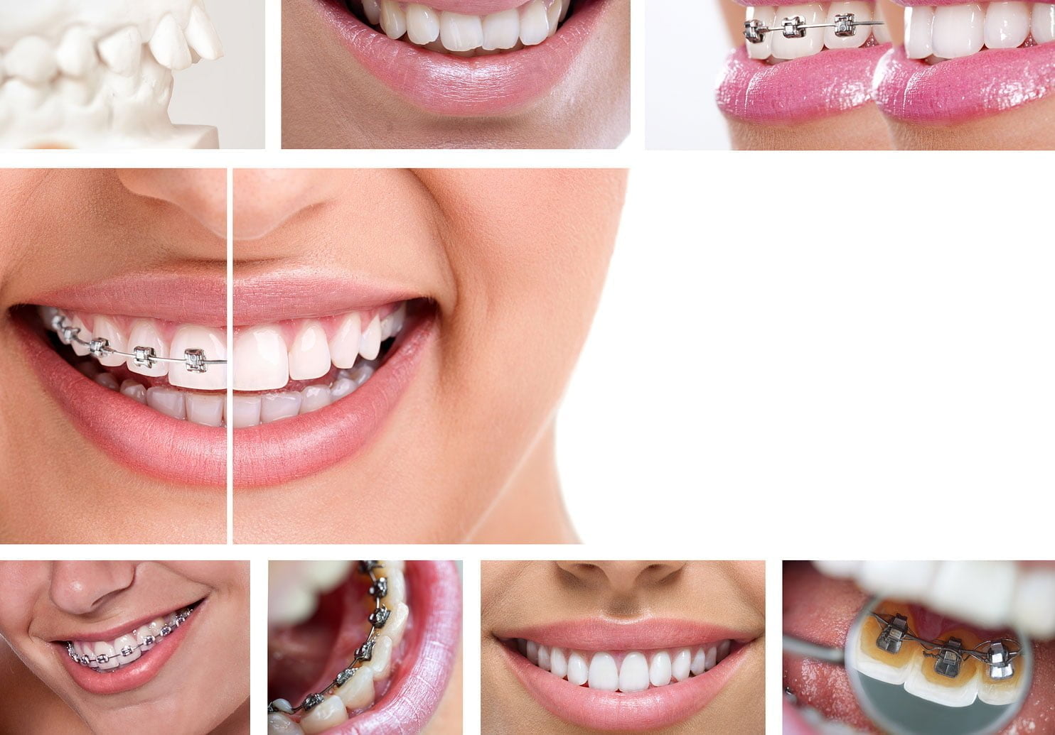 Orthodontics Braces Alanya Antalya