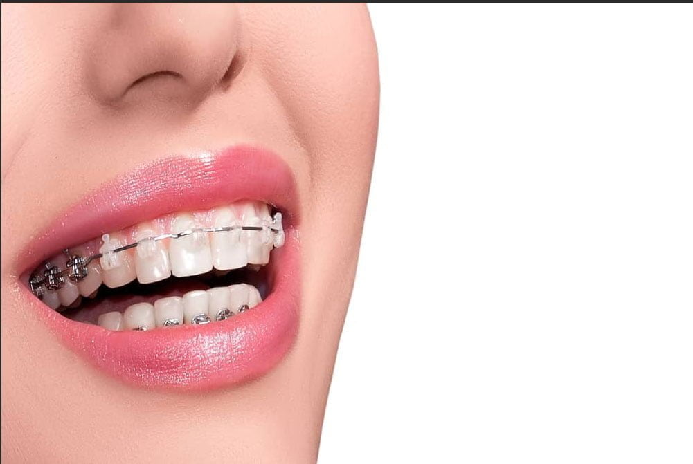 Orthodontics Braces Alanya Antalya