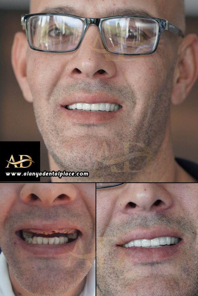 dental implant before after 3
