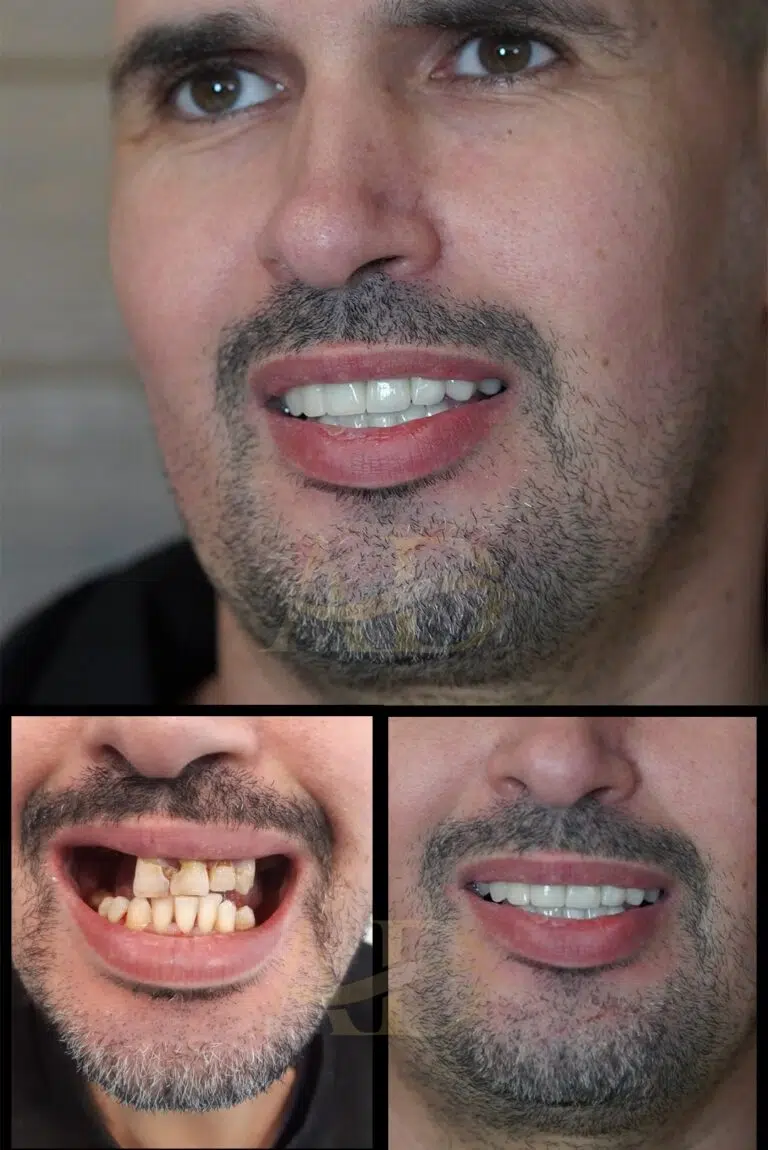 diş tasarımı önce sonra 4
