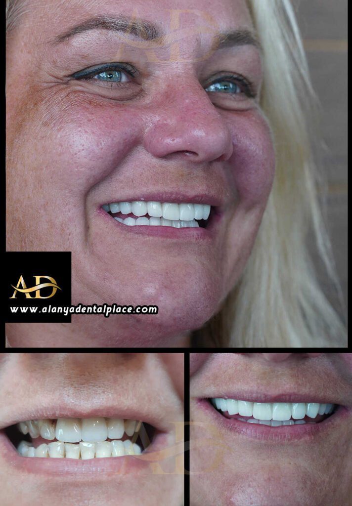 implant before after 6