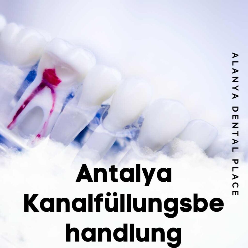 Antalya Kanalfüllungsbehandlung