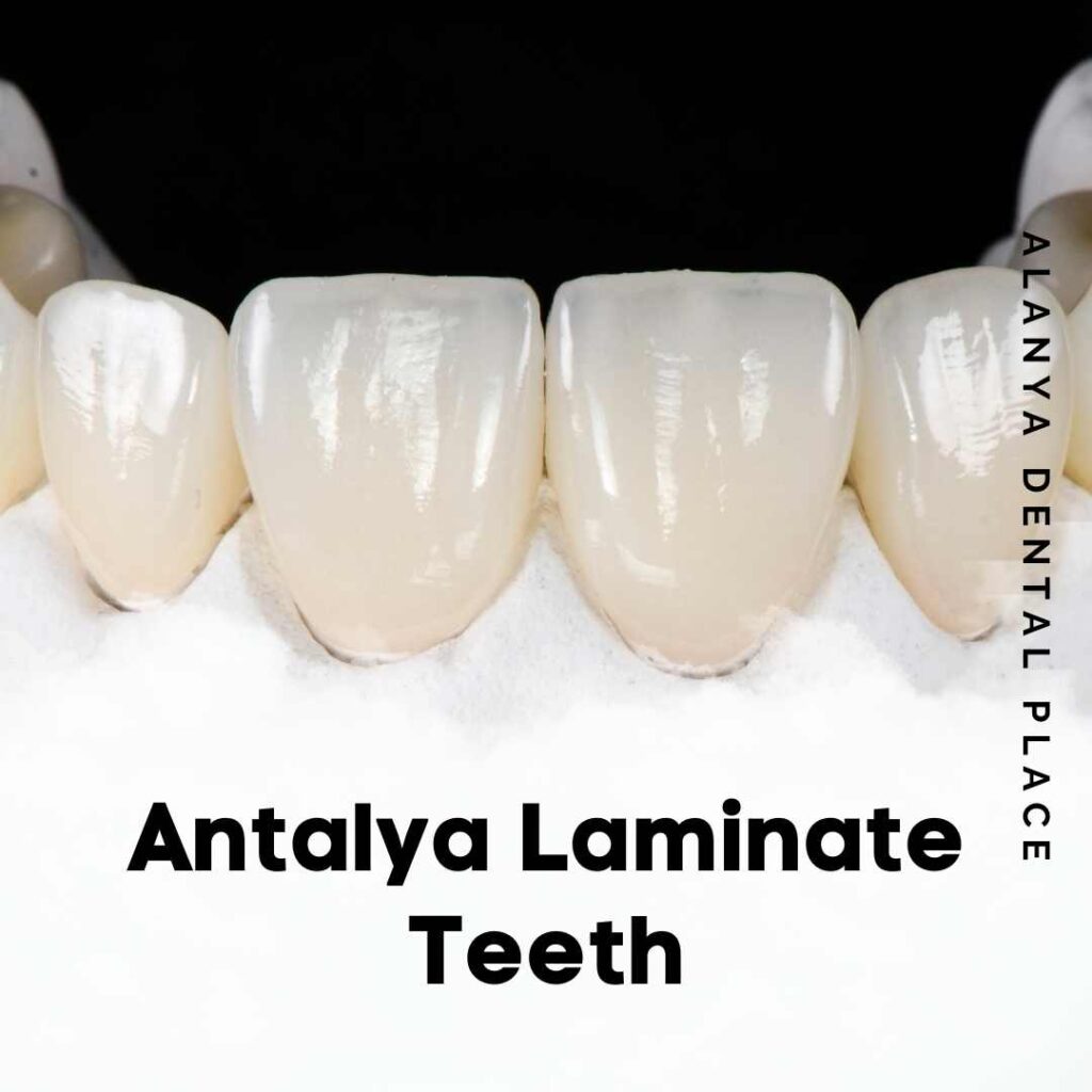 Antalya Laminate Teeth