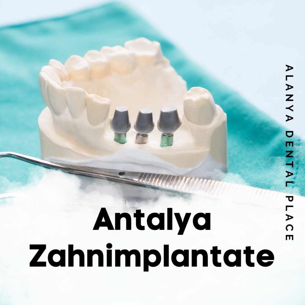 Antalya Zahnimplantate

