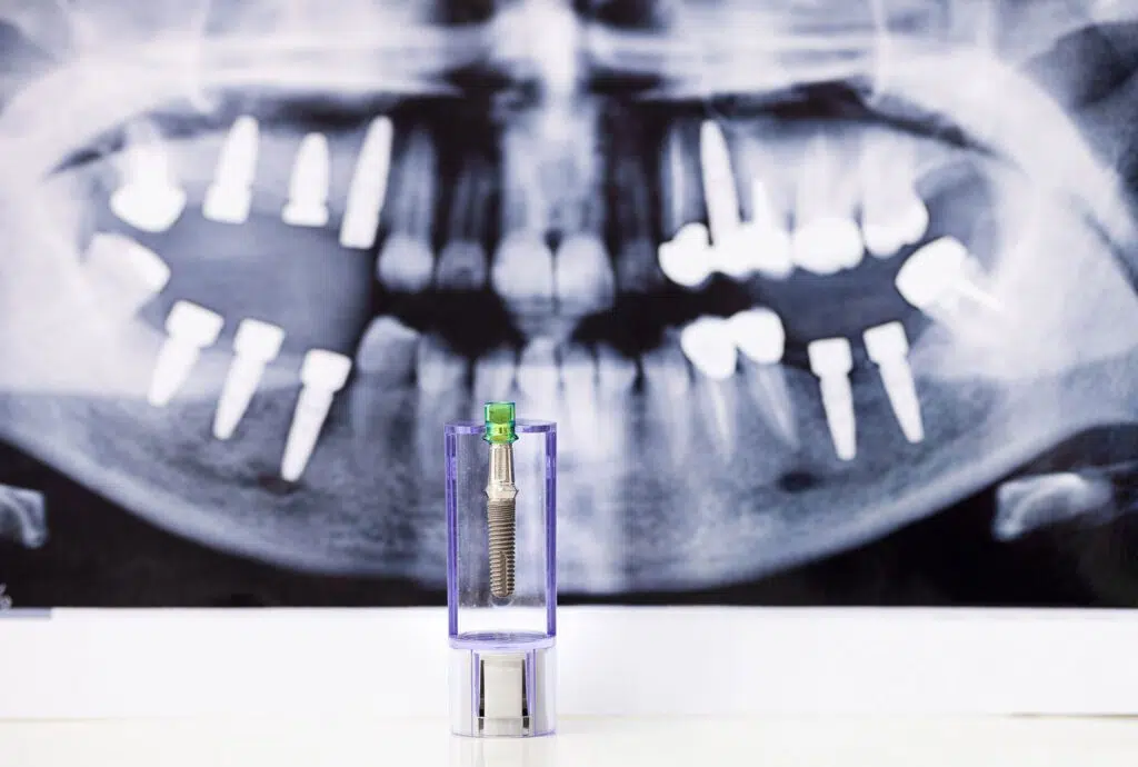 Does dental implant hurt