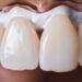 Zahnveneers und Preise