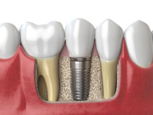 one-day-dental-implants
