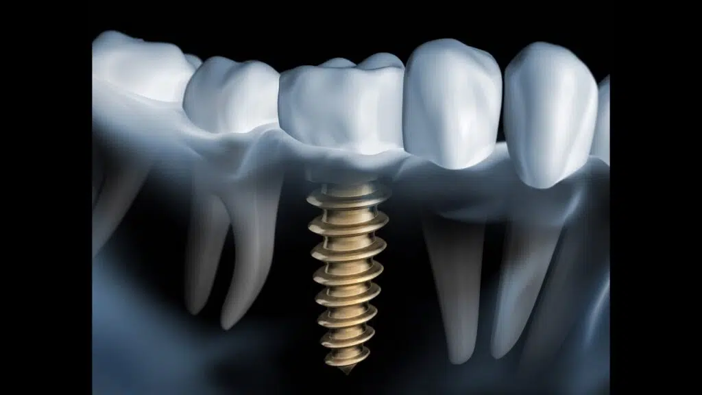 diş implant fiyatları 2023