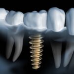 Какова средняя стоимость имплантации зубов?