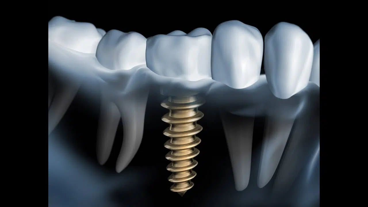 Какова средняя стоимость имплантации зубов?