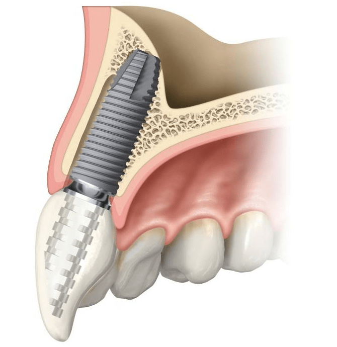 Which Type of Implant is Better