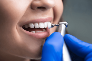 Was ist Zahnsteinreinigung? Wie wird sie durchgeführt?