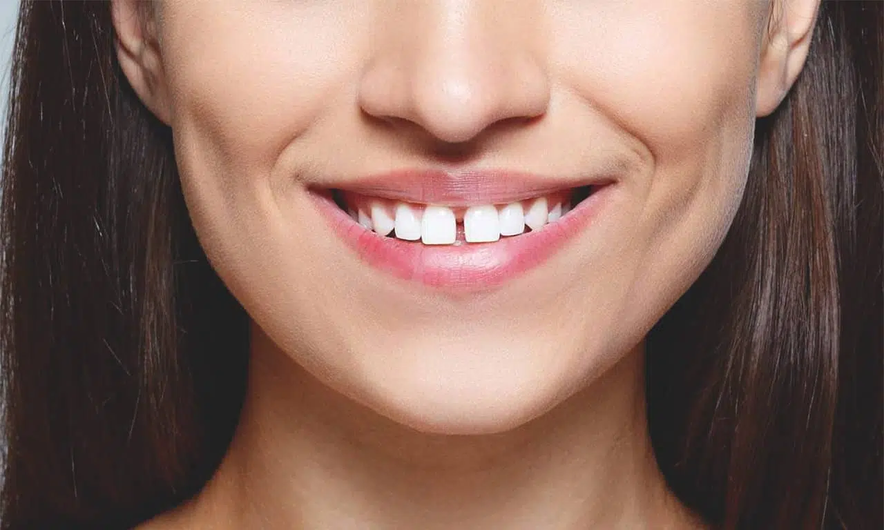 Dişler Arası Boşluk Nasıl Tedavi Edilir?