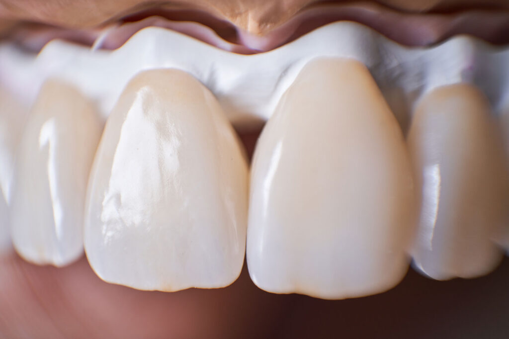 фарфоровые циркониевые зубы