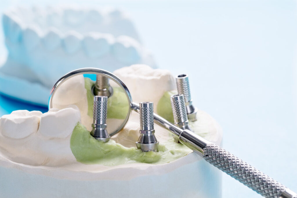 implants dentaires pour la bouche complete