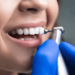 nettoyage de la couleur des dents
