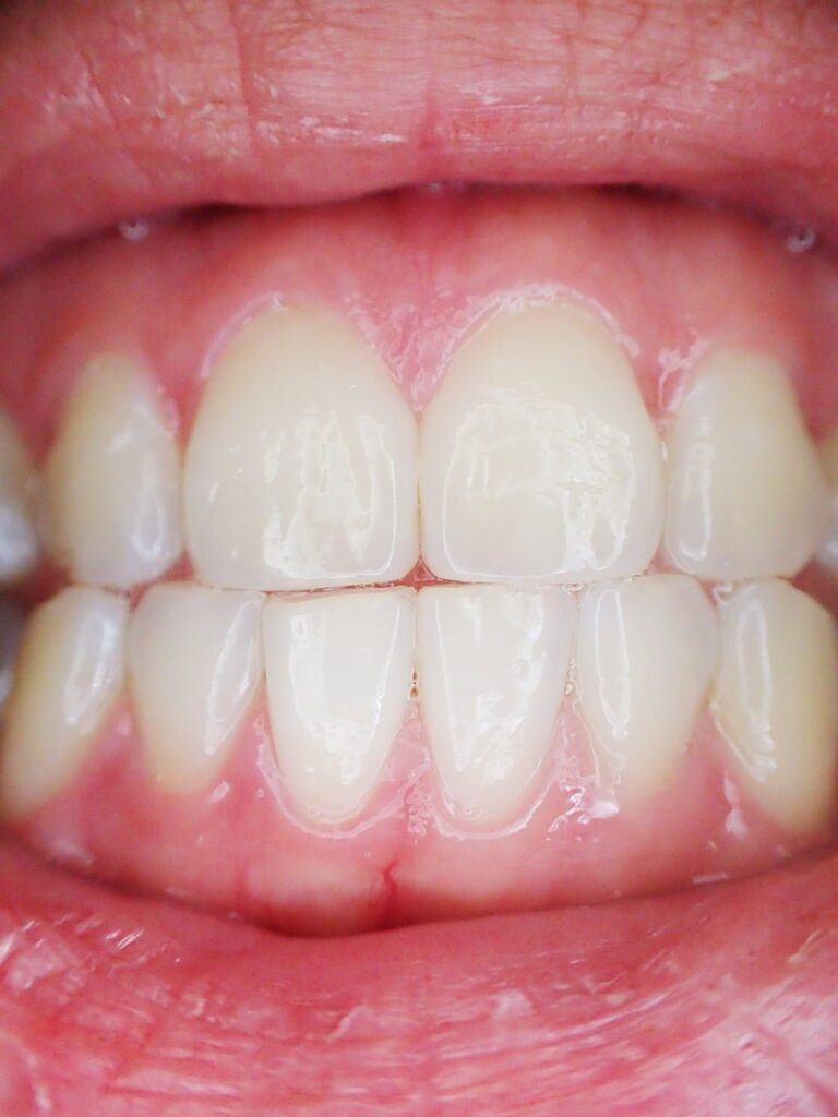 emax tooth veneers