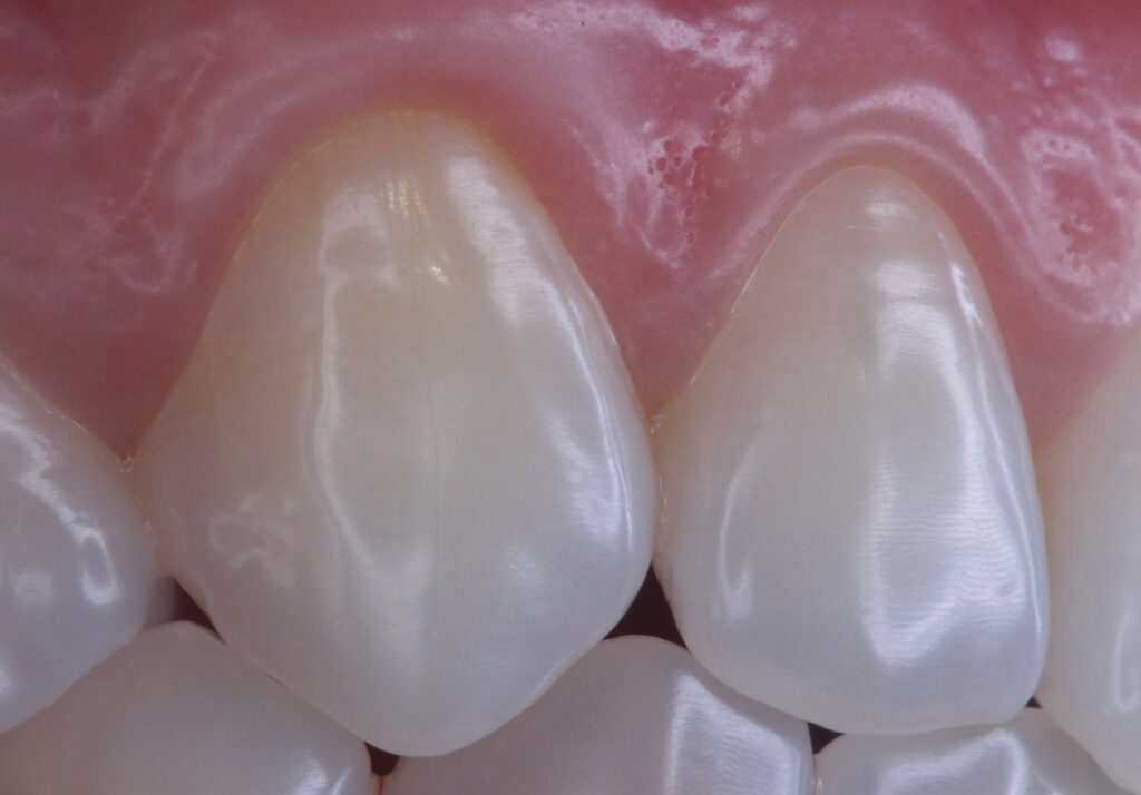 what is emax tooth crown
