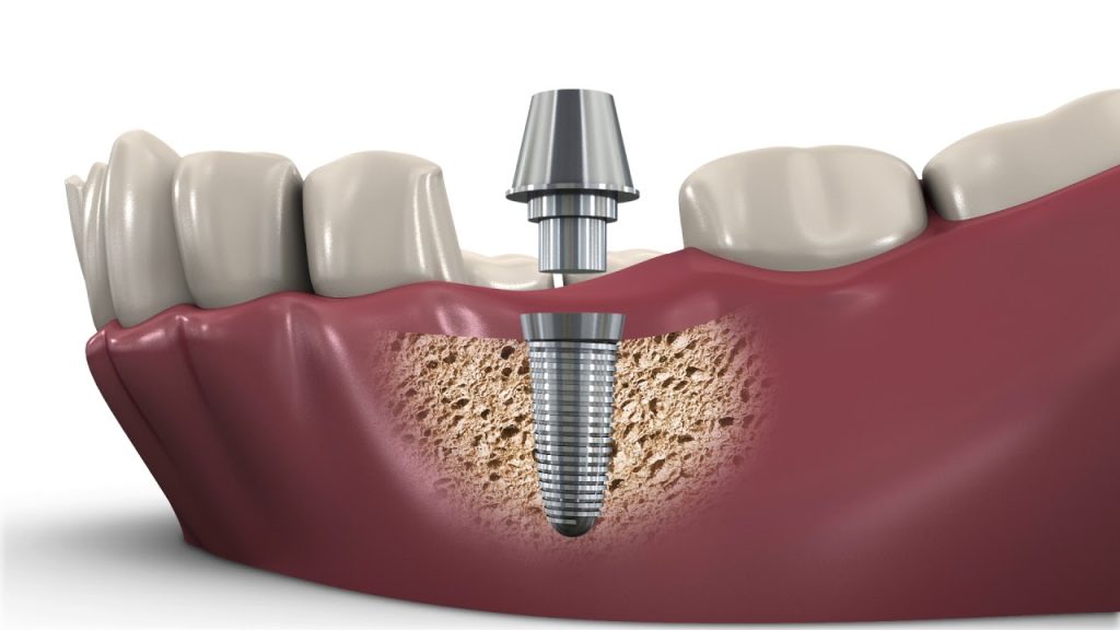 implant faydalari 2