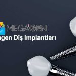 Виды и цены имплантатов Megagen