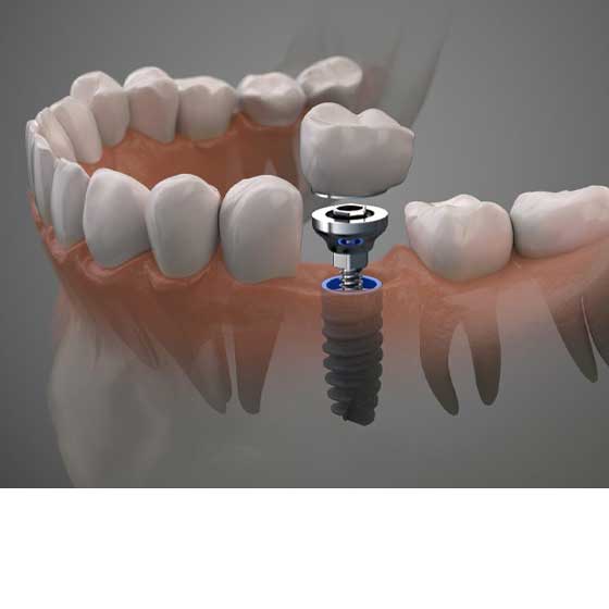Implant in 1 Day