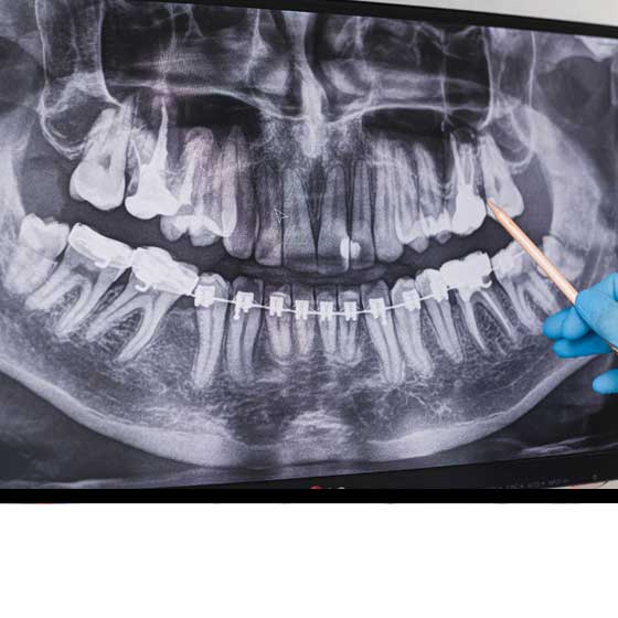 Tooth Extraction