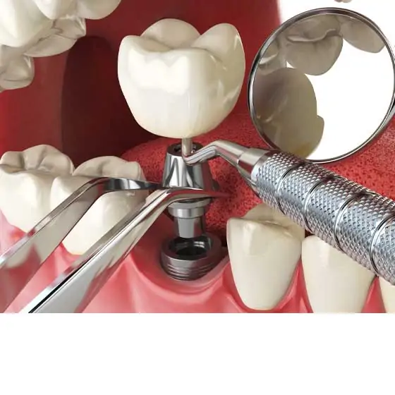 Dental Implant Treatment