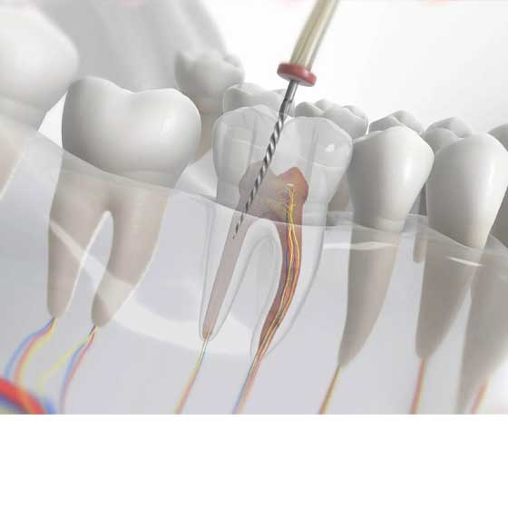 Root Canal Treatment