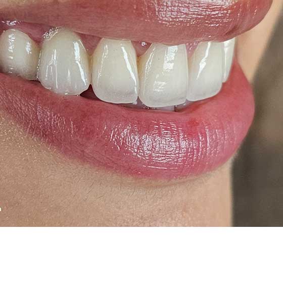 Zirconium Veneer