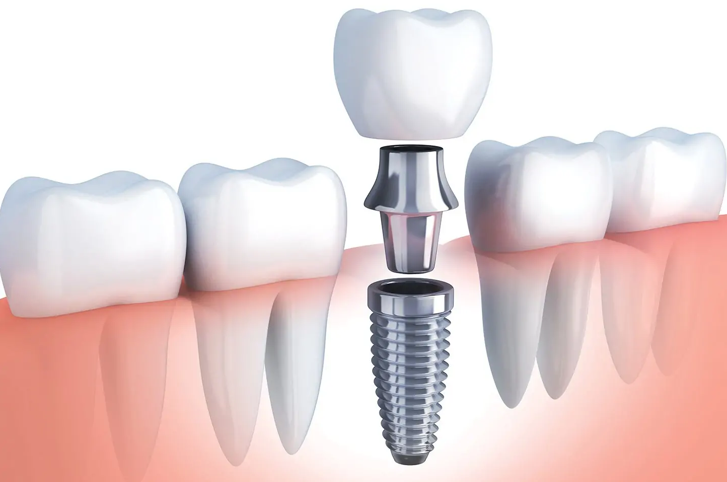 Benefits of Dental Implant and Answers to Questions