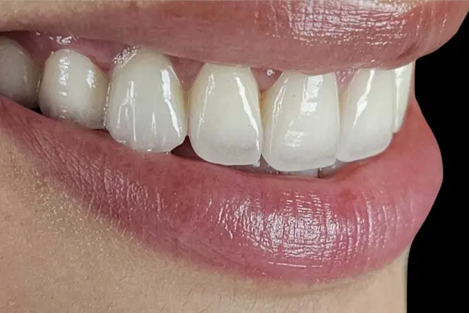 Zirconium Dental Crown