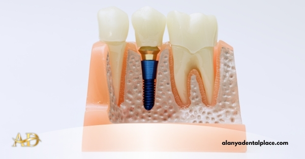 Bone Graft Surgery 2 Image link