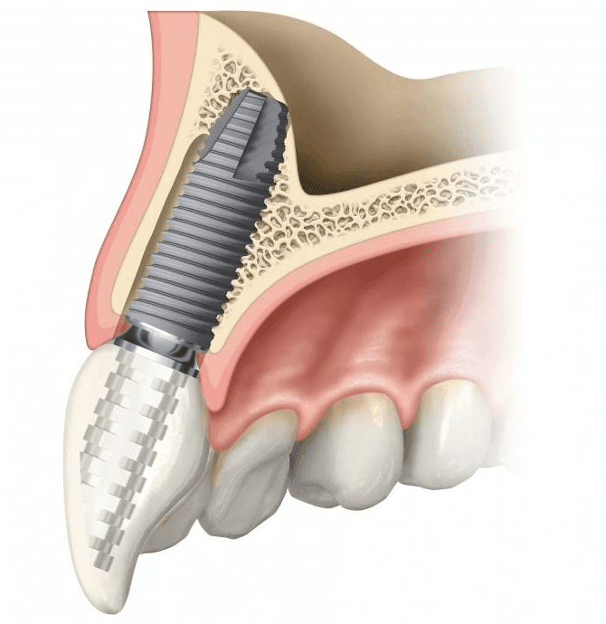 hangi tür implant daha iyi