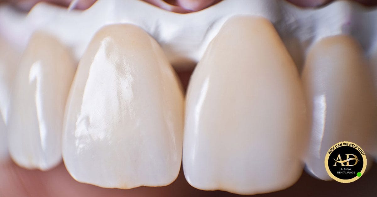 Facettes Dentaires Turquie 2 avantages des dents recouvertes