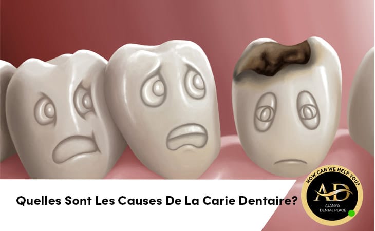 Quelles Sont Les Causes De La Carie Dentaire?