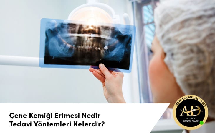 Çene Kemiği Erimesi Nedir ve Tedavi Yöntemleri Nelerdir?