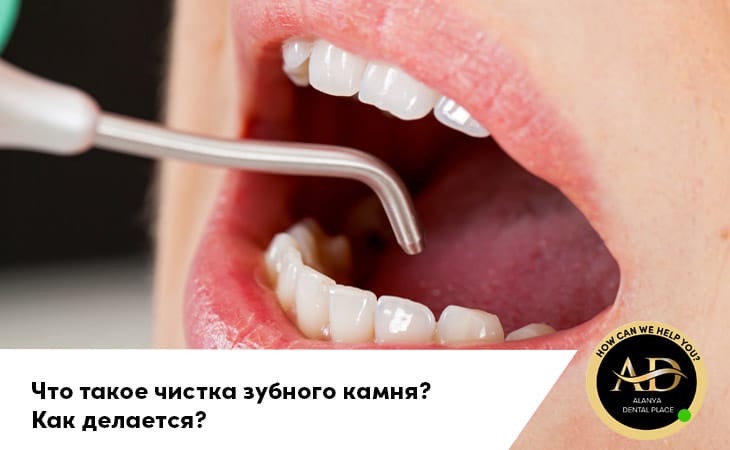 Что такое чистка зубного камня? Как делается?