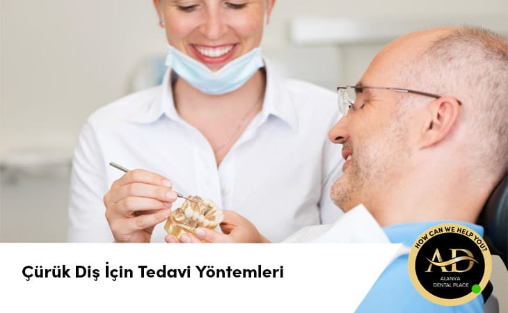 Çürük Diş İçin Tedavi Yöntemleri