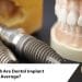 dental implant price