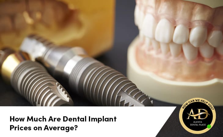 How Much Are Dental Implant Prices on Average?