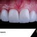 Dental Veneers Turkey